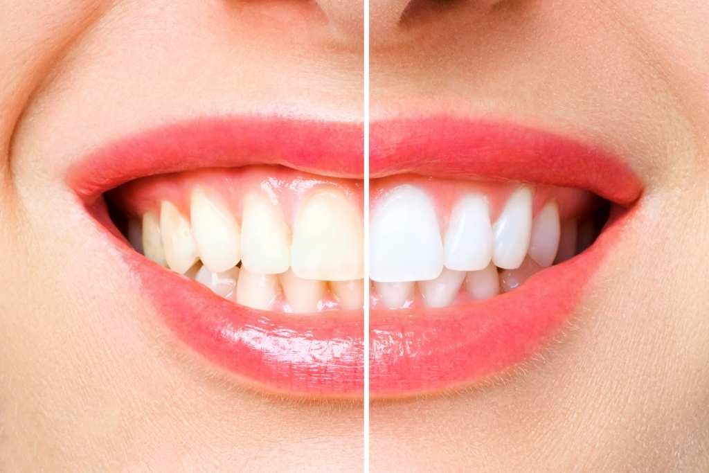 Teeth whitening north york