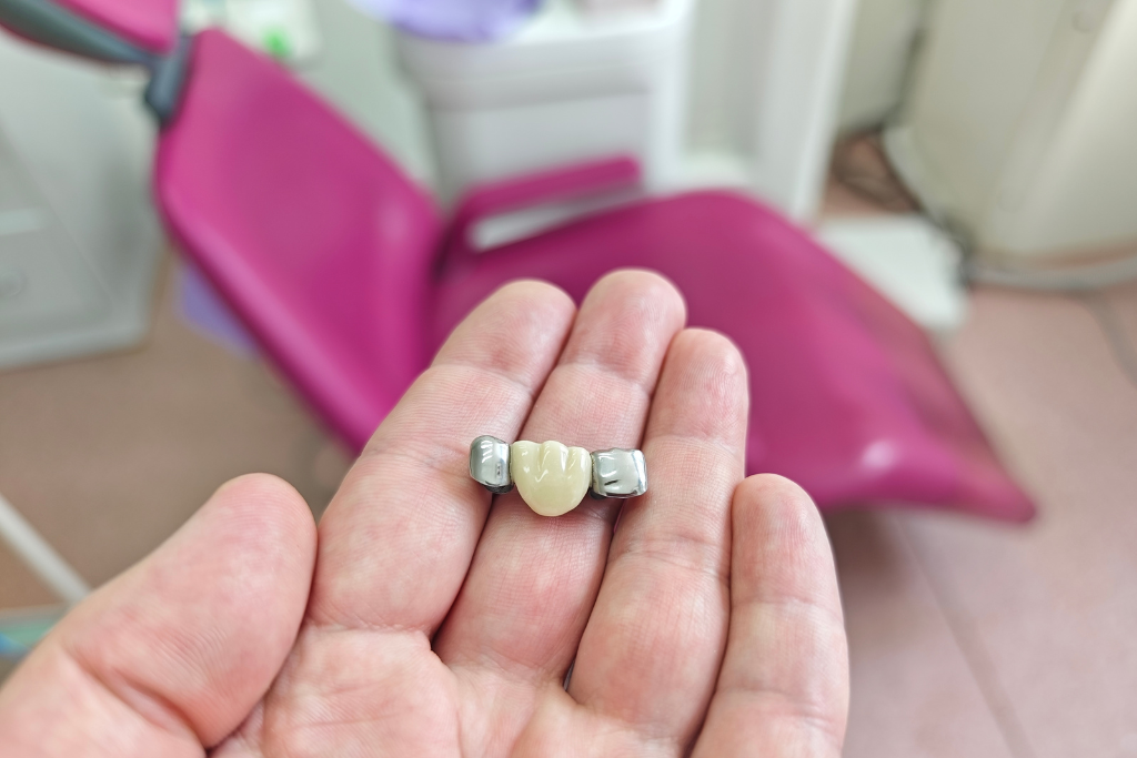 dental bridges near you in north york