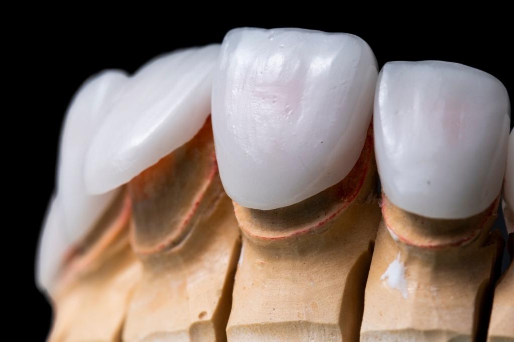 porcelain veneers in north york