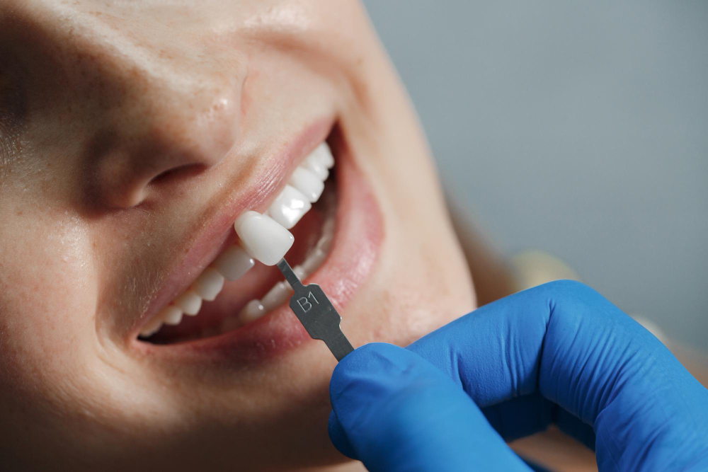 Types of Dental Crowns Which One is Right for You